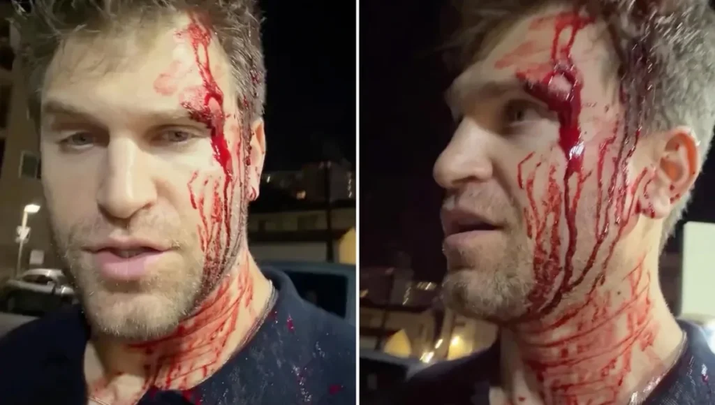‘Pretty Little Liars’ Star Keegan Allen Robbed at Gunpoint and Beaten in West Hollywood